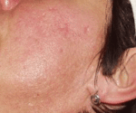 Acne20Scar_After20Laser.gif