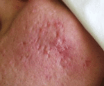 Acne20Scar_Before20Laser.gif