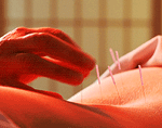 Acupuncture20Needles.gif