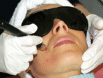 Laser20Treatment.gif