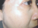 Pigmentation_After20VPL.gif