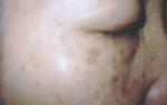 Pigmentation_Before20VPL.gif